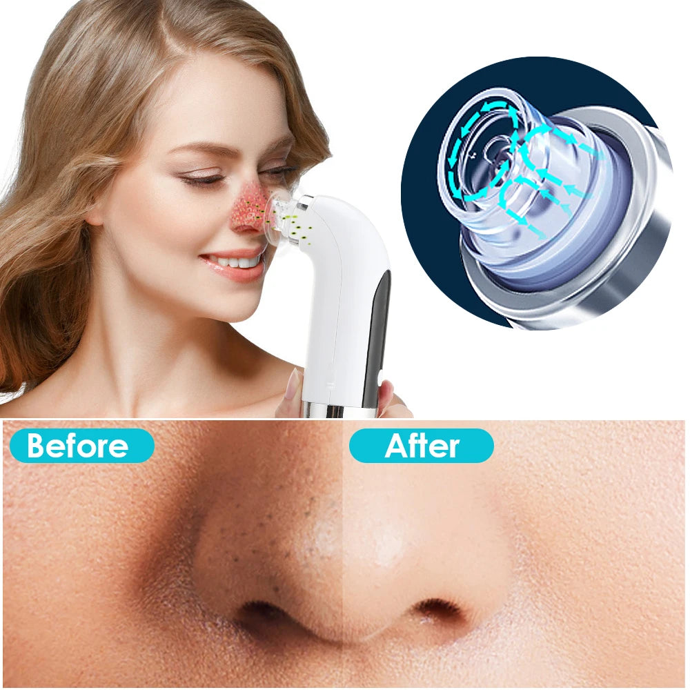 Blackhead Bubble Remover